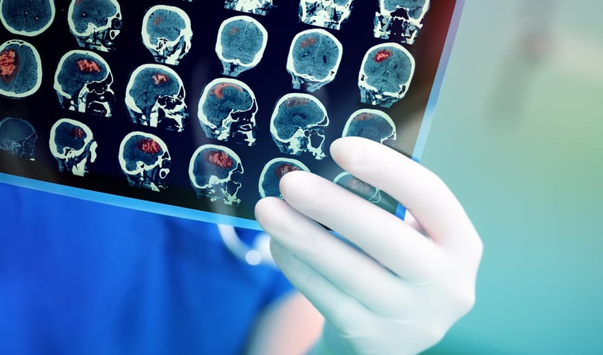 prevenire malattie cerebrovascolari