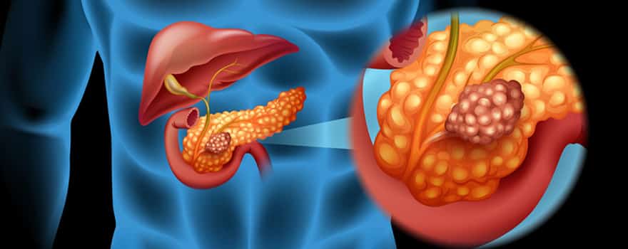 tumore pancreas neuroendocrino