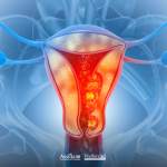 Rappresentazione medica 3D dell'apparato riproduttivo femminile con evidenziata una lesione per spiegare perché nel tumore al collo dell’utero è cruciale la prevenzione.