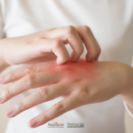 Primo piano di una persona che gratta il dorso della mano arrossata a causa di orticaria da freddo.